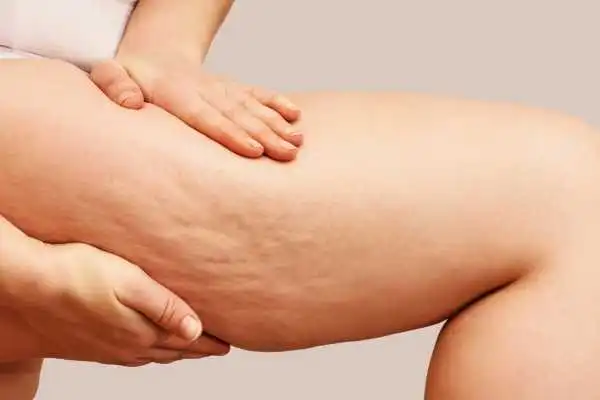 Image of woman showing leg with cellulite Westwood