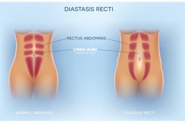 What Non-Surgical Options Are Available for Diastasis Recti Westwood?