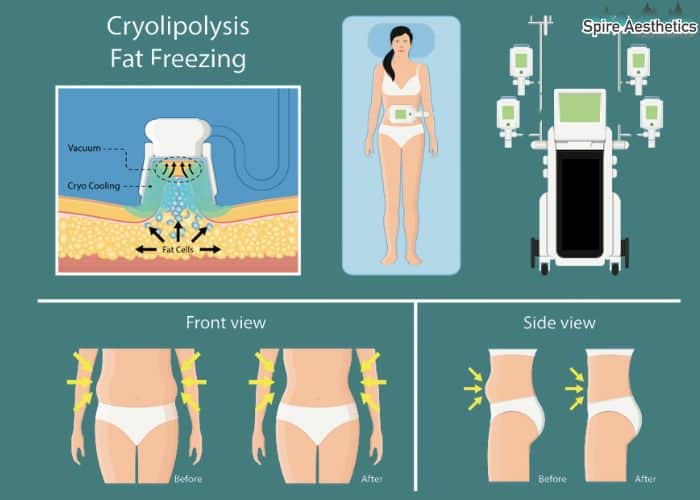 Image of diet and fat freezing combined for best results for Spire Aesthetics Westwood