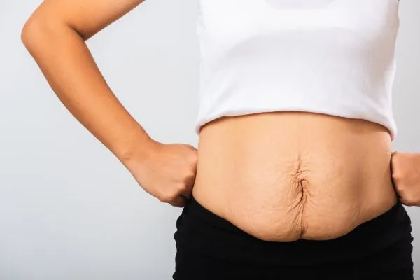 Image of a woman's stomach after weight loss with sagging skin following a gastric band Westwood