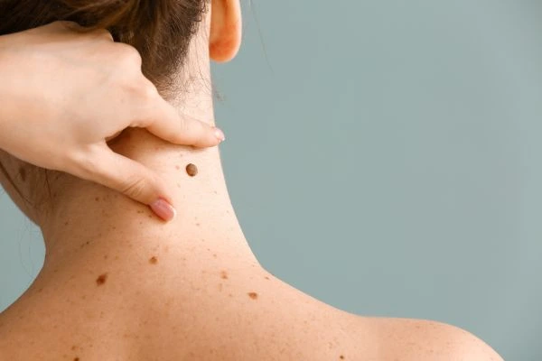 skin blemish removal Westwood treatment