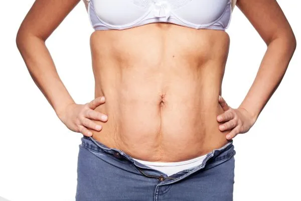 sagging skin on woman's stomach after weight loss injections Westwood