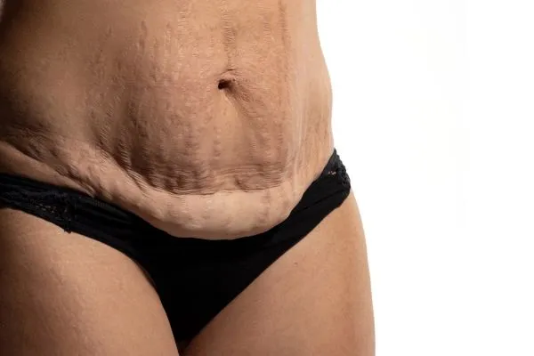 Image of womans stomach after weight loss injections Westwood showing saggy skin